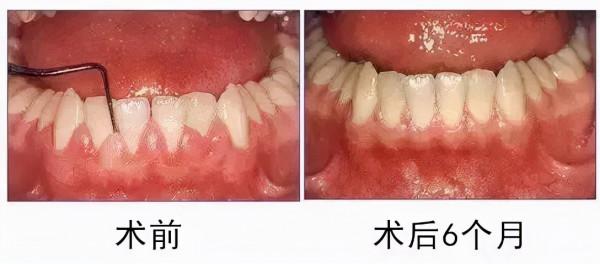 牙齦上長膿包，擠掉後還反覆長出，怎麼回事？