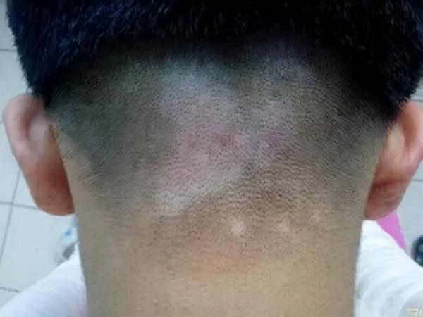 白癜風到了冬季病症減輕好轉，可以停藥嗎？