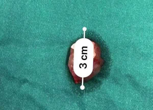 30歲二胎媽媽臨產前查出心臟腫瘤,手術檯上一邊生娃一邊開“心” 30歲二胎媽媽臨產前查出心臟腫瘤,手術檯上一邊生娃一邊開“心”