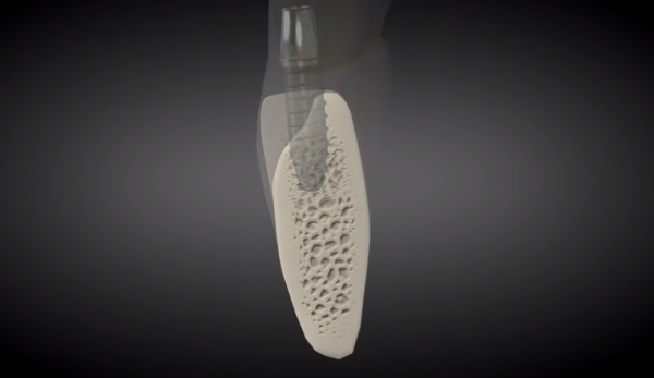 口腔種植最好用什麼植骨材料？