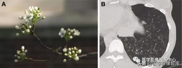 22個肺部疾病的CT徵象 22個肺部疾病的CT徵象