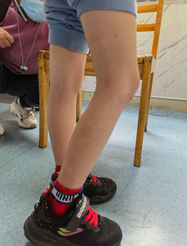 7歲孩子怎會半月板撕裂？這種情況近年來愈發增多，家長們都該聽聽