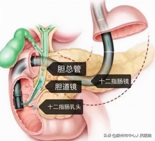 消化內科成功開展兩例新技術為患者帶來福音