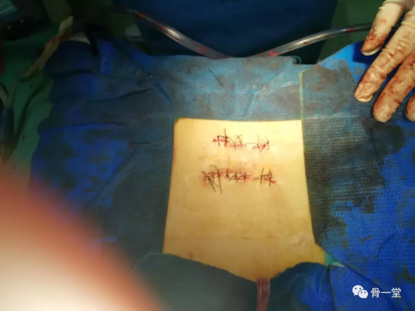 真正的脊柱微創-misTLIF入路經脊柱內鏡下椎管減壓融合治療