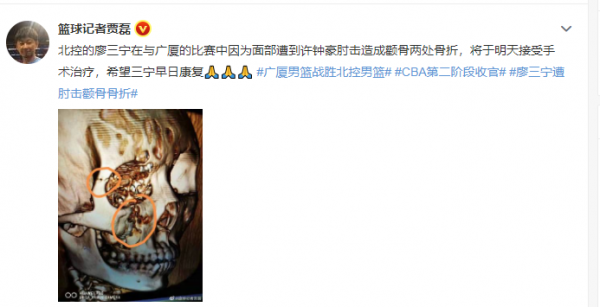 許鍾豪肘擊廖三寧面部兩處骨折，賽季徹底報銷