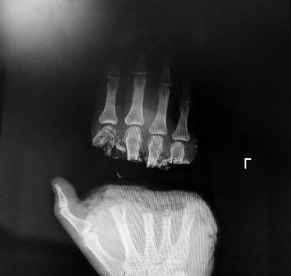 手被斬斷10小時！哈醫大一院創傷骨科專家連闖“三關”完成斷手續接