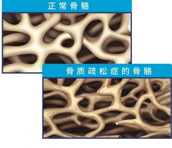 樂健康 | 1分鐘測出骨質疏鬆高危人群，專家給出防治特定建議