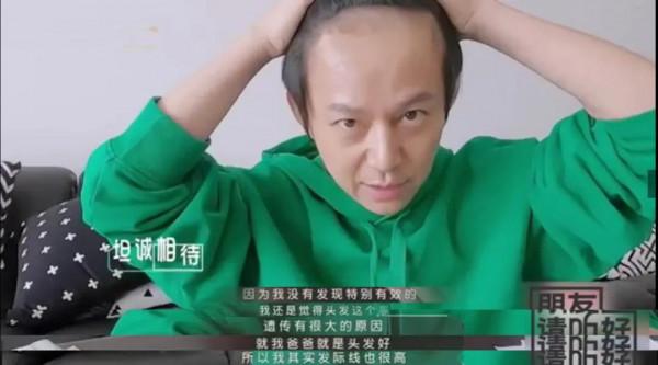 &OpenCurlyDoubleQuote;禿頂&rdquo;危機的9大男神，有人29歲髮際線堪憂，有人戴了多年假髮