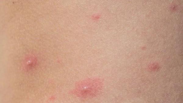 閆玉紅健康課堂丨秋季面板易長“癰”，原來是這麼回事！