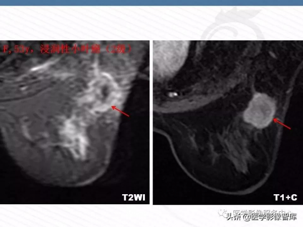 乳腺T2WI高訊號腫瘤病變的診斷思路 乳腺T2WI高訊號腫瘤病變的診斷思路