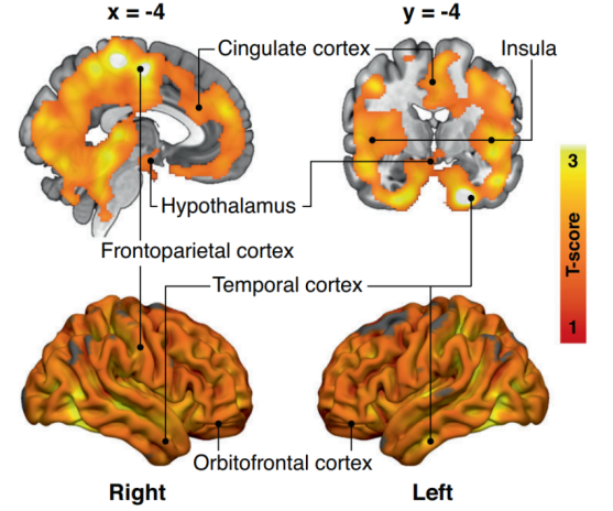 《自然》子刊：胖人先“胖”腦！科學家首次發現，在男性發胖之前，大腦已經出現了促肥胖的變化丨臨床大發現
