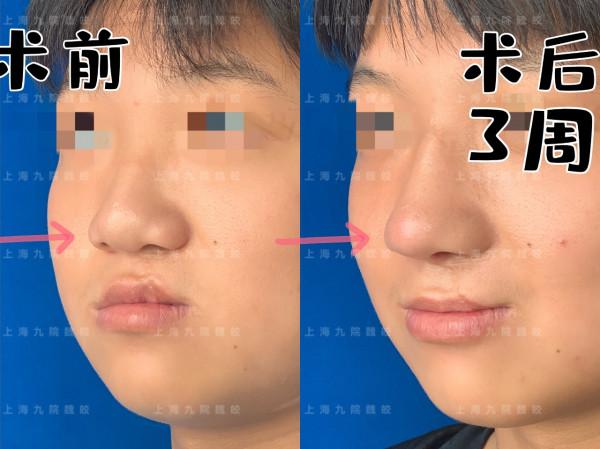 鼻畸形隆鼻矯正案例分享
