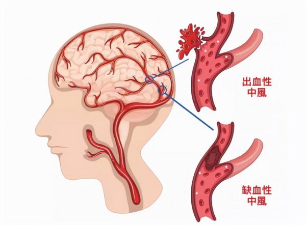 血壓高到多少才會發生腦出血?醫生給出參考值,建議心裡有數 血壓高到多少才會發生腦出血?醫生給出參考值,建議心裡有數