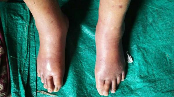 老人腳腫怎麼回事？常言道：“男怕穿靴，女怕戴帽”，是否如此