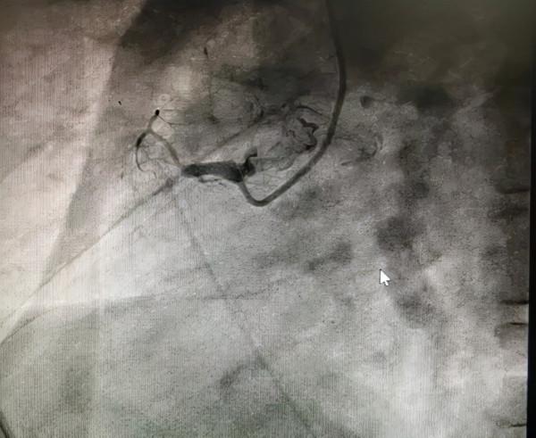 再克技術堡壘，巧破閉塞病變