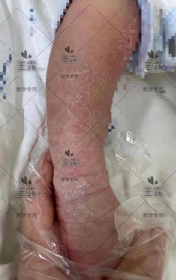 新生兒一過性面板病（上）