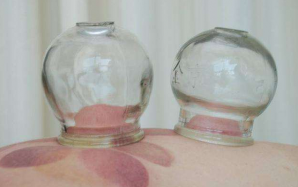 拔火罐吸出來的淤血，是體內的毒素？告訴你真相，看完漲知識了