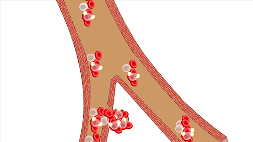 把健康帶回家 &vert; 寒冷天氣心血管疾病的預防