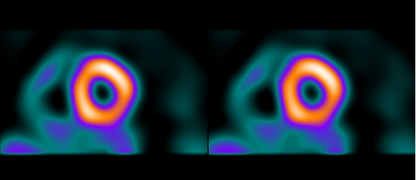 聚焦心臟！GE推出新一代核醫學掃描器