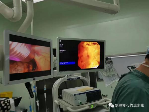 膽道鏡是個啥東東？