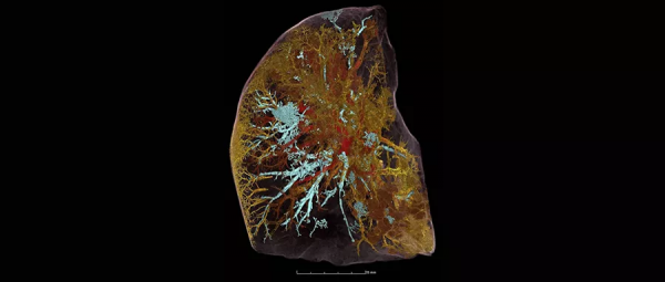 最強X光-首揭確診者肺部損傷細節