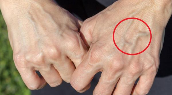 有的人青筋暴起,有的人卻看不到青筋,哪些部位出現青筋需要重視 有的人青筋暴起,有的人卻看不到青筋,哪些部位出現青筋需要重視