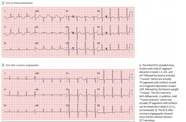 病例 | 心電圖挑戰:持續胸痛患者,一過性ST段抬高、QTc間期延長 病例 | 心電圖挑戰:持續胸痛患者,一過性ST段抬高、QTc間期延長