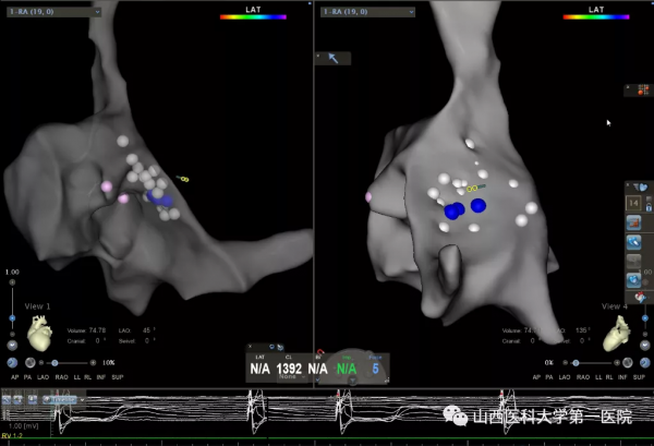 山西醫科大學第一醫院完成山西省首例經房間隔左室心內膜起搏