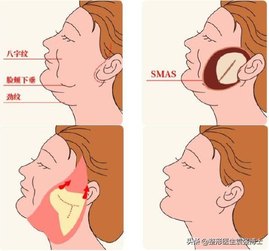 拉皮手術“落伍”了，早都“過時”了？