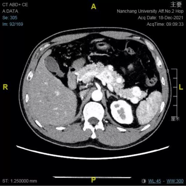 南昌大學二附院耳鼻咽喉頭頸外科成功診治鼻腔鼻竇轉移性腎透明細胞癌患者