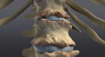 夜間或晨起腰痛，活動後會有緩解，醫生：別被誤導為腰椎間盤突出