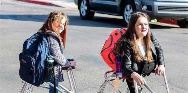 雙胞胎女嬰腹部相連醫生都說活不了，4歲做分離手術如今已滿20歲