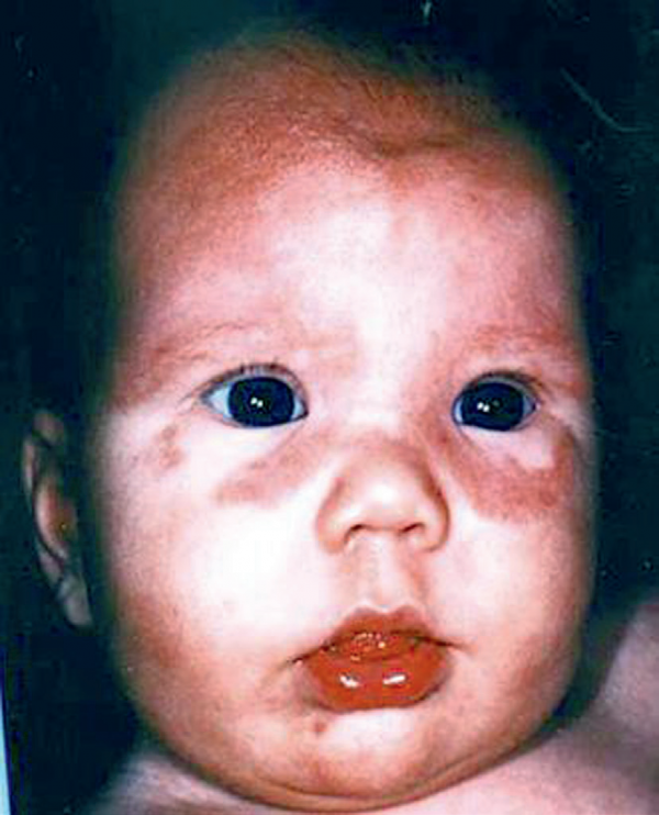 如何看待抗SSB抗體? 如何看待抗SSB抗體?