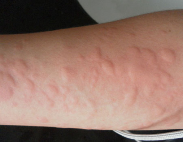 3歲男孩過敏性鼻炎,得隨身佩戴“空氣清淨機” 3歲男孩過敏性鼻炎,得隨身佩戴“空氣清淨機”