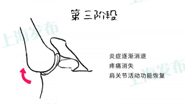 @40~60歲人群，這種難以忍受的肩疼可以自愈