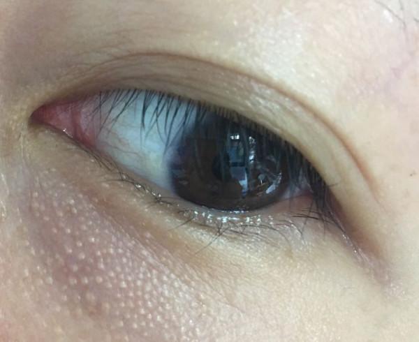 千元眼霜用完長了密密麻麻的脂肪粒?真的是眼霜的問題嗎? 千元眼霜用完長了密密麻麻的脂肪粒?真的是眼霜的問題嗎?