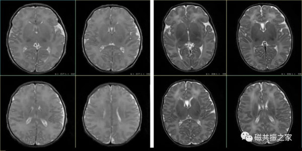 嬰幼兒MRI該如何掃描？一文歸納