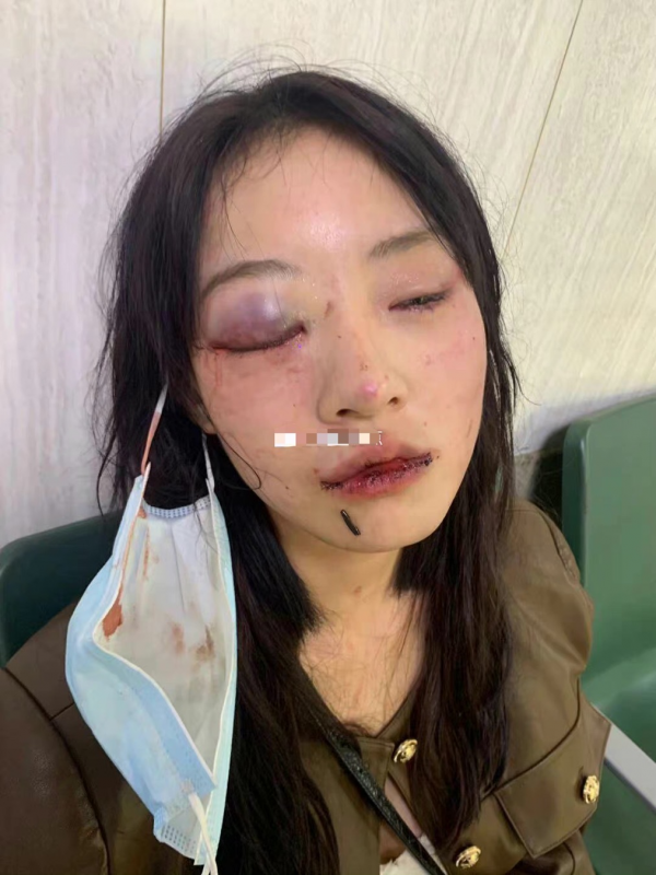 百萬網紅疑遭男友家暴，眼睛青紫滿臉抓痕，傷勢過重讓人認不出