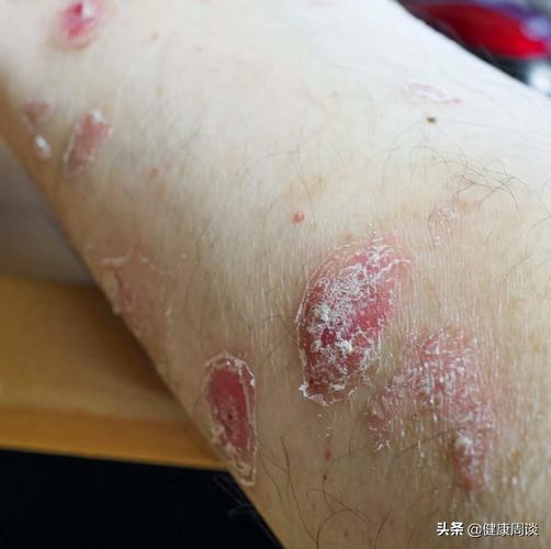 牛皮癬會傳染嗎？得了牛皮癬後怎麼辦？這三種護理方法不能忽視