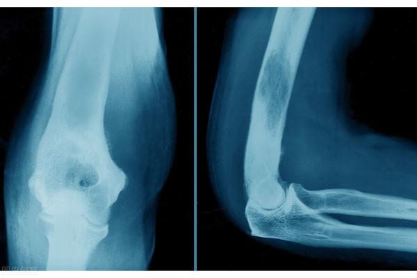 經典醫案分享：關節疼痛、腫大莫忽視，可能與這種腫瘤有關