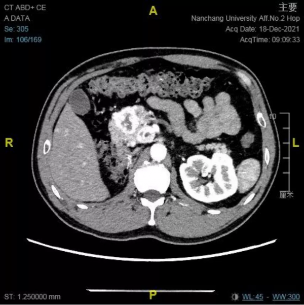 南昌大學二附院耳鼻咽喉頭頸外科成功診治鼻腔鼻竇轉移性腎透明細胞癌患者