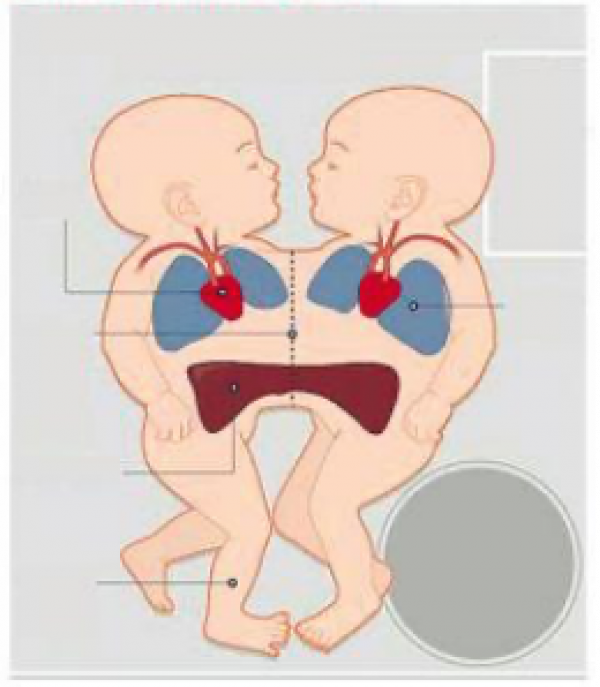 兩個大腦指揮一個身軀,真的能保證不吵架嗎?連體嬰生活大揭秘 兩個大腦指揮一個身軀,真的能保證不吵架嗎?連體嬰生活大揭秘