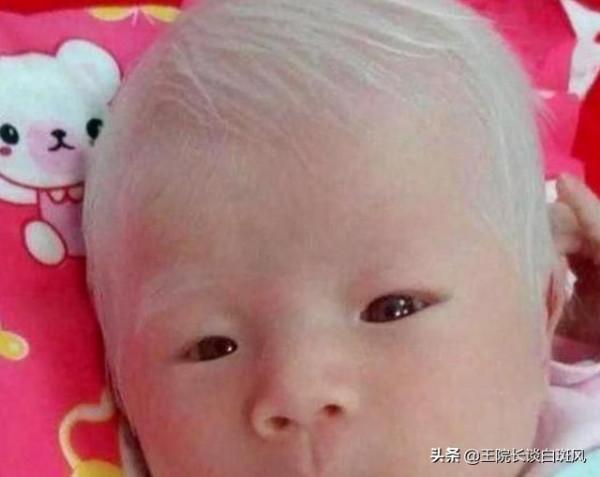 孩子頭髮變白先別慌！一文告訴你掛哪個科室