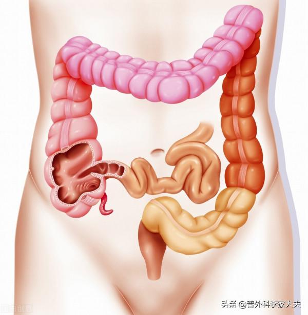 主任:為什麼未做腸鏡,你就知道患者是乙狀結腸癌? 主任:為什麼未做腸鏡,你就知道患者是乙狀結腸癌?