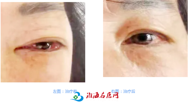 市一院眼科、介入與血管外科攜手為患者精準診治