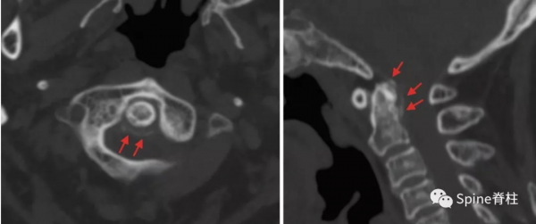頸椎少見的3種鈣化性疾病 頸椎少見的3種鈣化性疾病