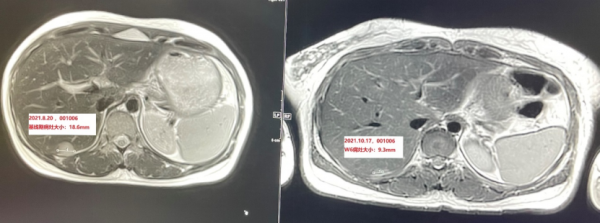 「新藥招募」新型抗體藥物偶聯藥物MRG003