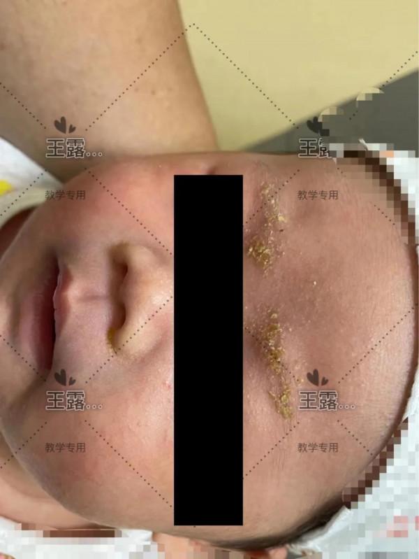 新生兒一過性面板病（上）