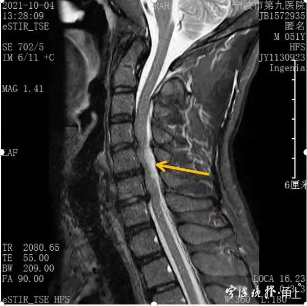 男子肩頸疼痛，2小時後全身失去知覺！醫生：嚴重可瞬間致命！平常這些舉動很危險…