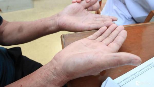 看手掌可以查肝病?這個說法你聽過嗎? 看手掌可以查肝病?這個說法你聽過嗎?